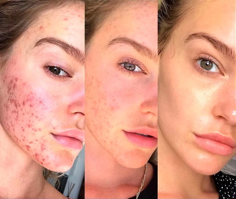 Luxurise High Frequency Skin Care Tool