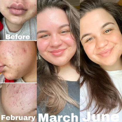 Luxurise High Frequency Skin Care Tool